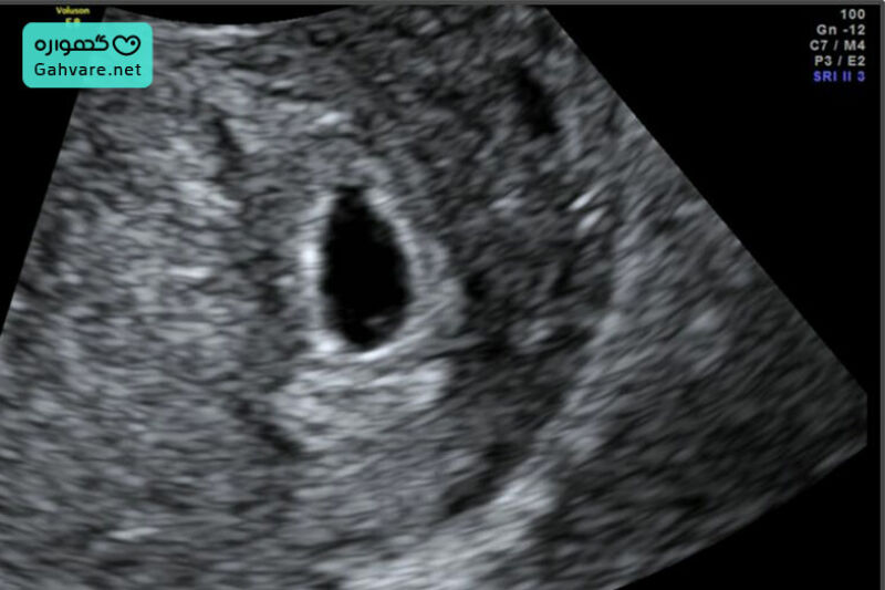 وضعیت جنین در هفته پنجم بارداری