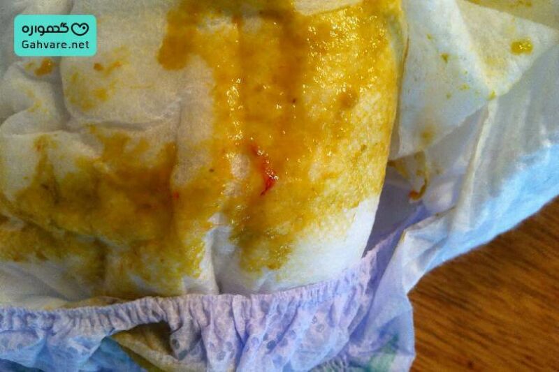 خون در مدفوع نوزاد چهار ماهه