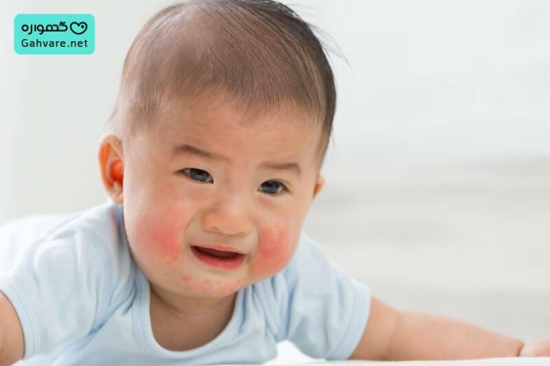 نشانه های آلرژی به موز در نوزاد