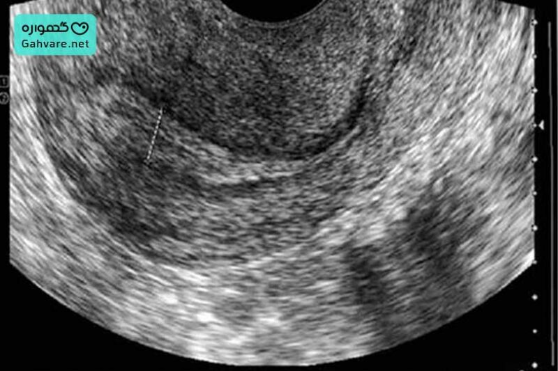 ضخامت آندومتر برای بارداری