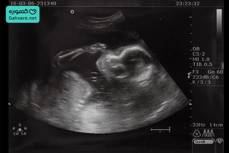 آزمایش و سونوگرافی هفته سیزدهم برداری