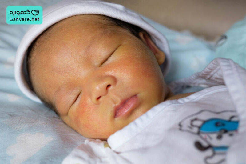 تشخیص زردی نوزاد