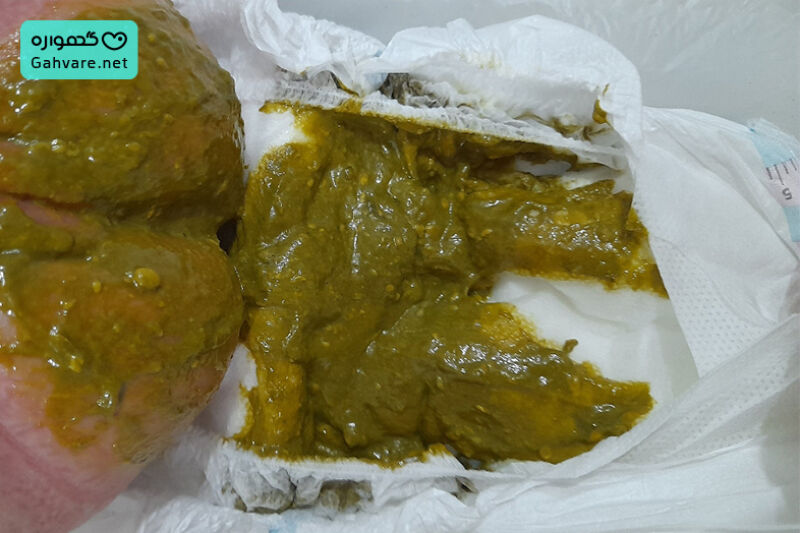 مدفوع سبز در نوزاد شیرخوار