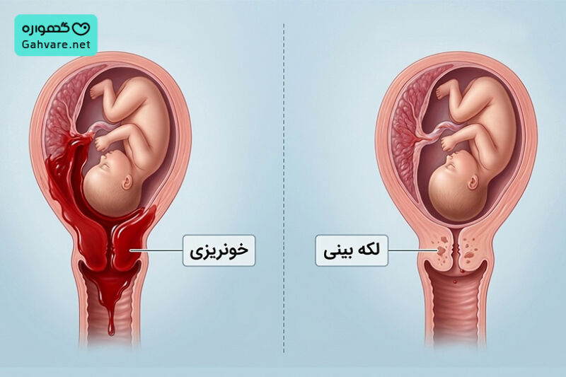 تفاوت خونریزی و لکه بینی در بارداری