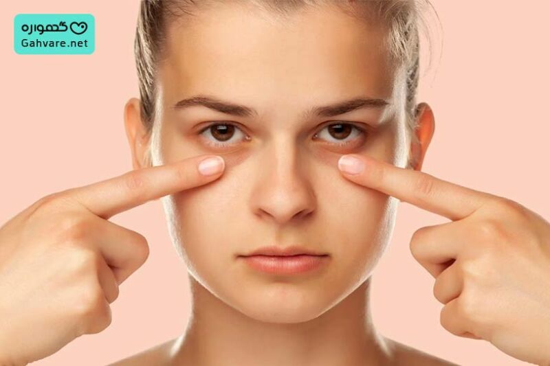 سیاهی زیر چشم در بارداری در اثر کم خونی
