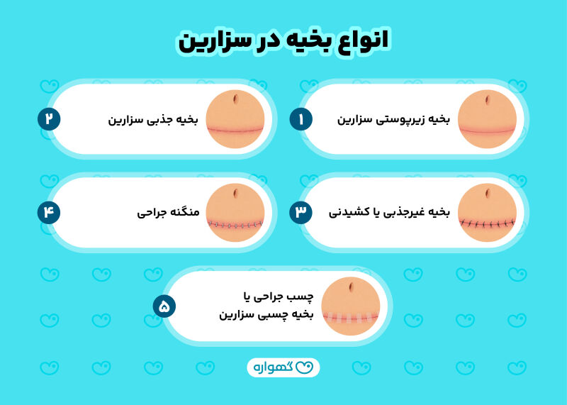 انواع بخیه در سزارین