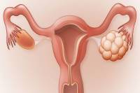 سندرم تخمدان پلی کیستیک در بارداری