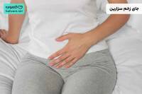 جای زخم سزارین