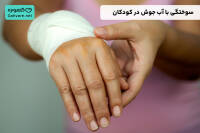 درمان سوختگی با آب جوش در کودکان