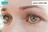 عفونت چشم در بارداری