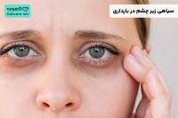 سیاهی زیر چشم در بارداری